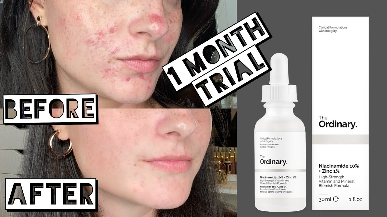 The Ordinary Salicylic Acid 2% Solution – Water-Based Blemish Control Serum