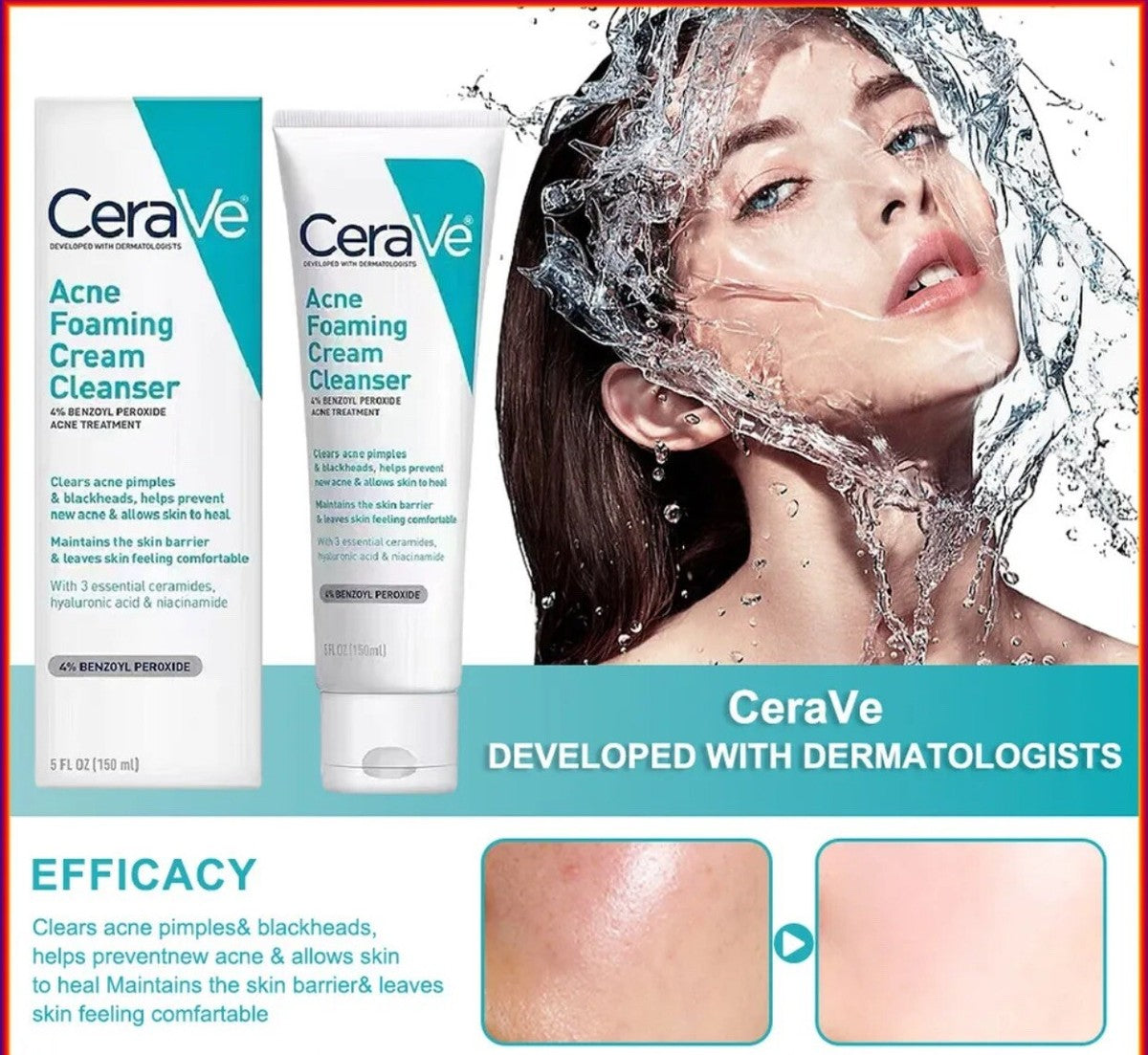 CeraVe Acne Foaming Cream Cleanser 150ml – 4% Benzoyl Peroxide Acne Treatment